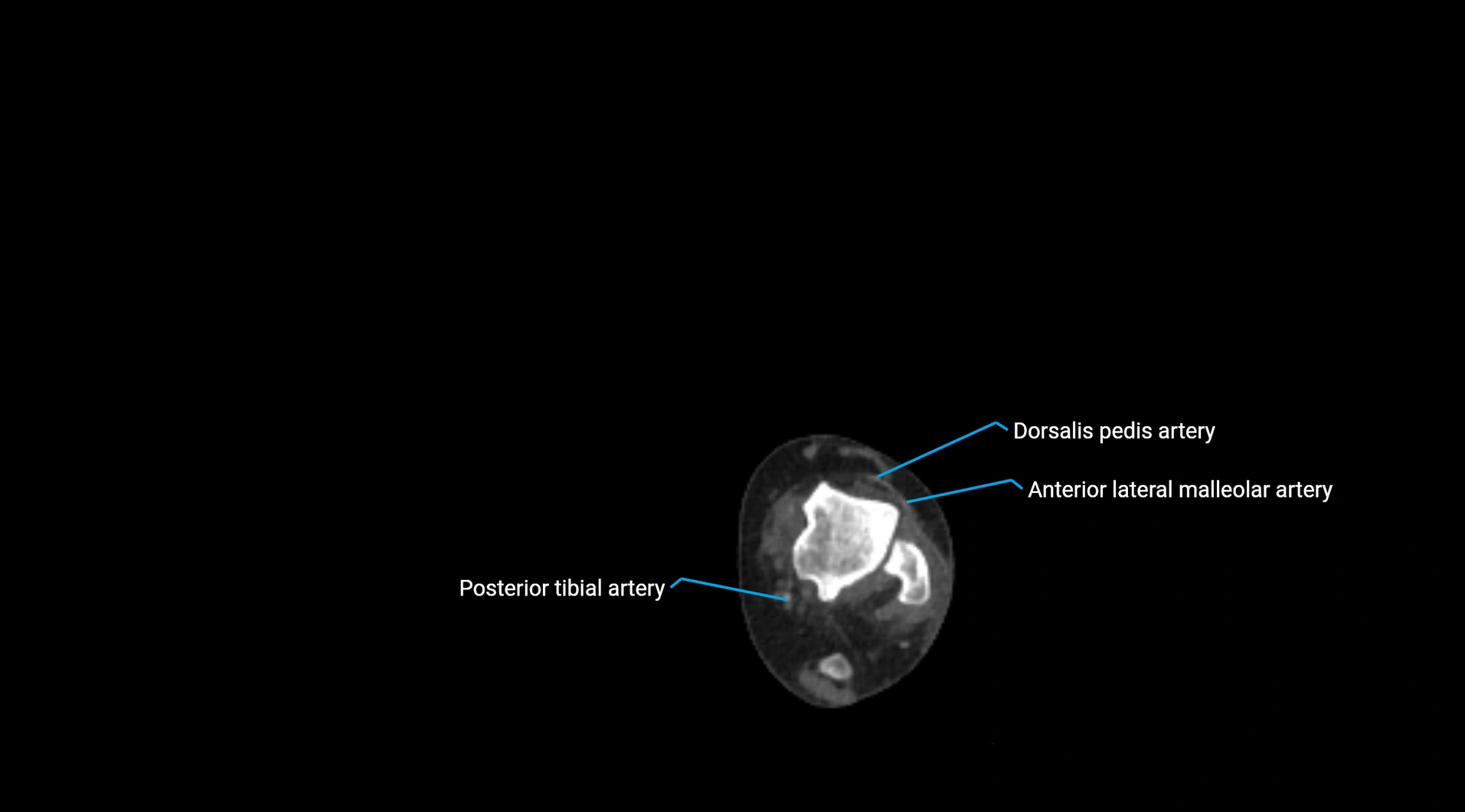 CTA lower limb cross sectional anatomy labelled image _275.webp